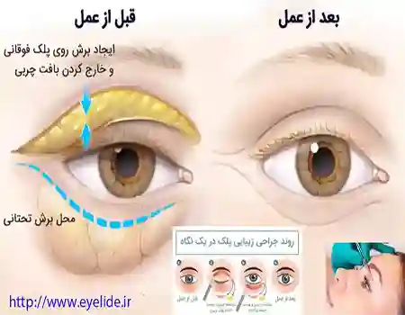جراحی بلفاروپلاستی پلک پایین و بالا